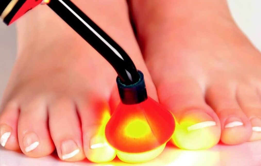 Iltze plakaren laser tratamendua
